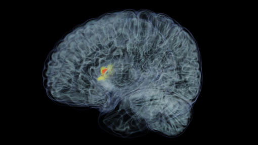 Brain Tumor Growth Simulation Image